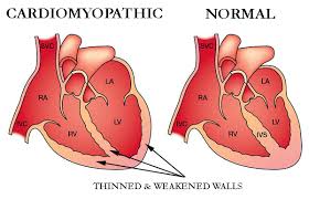 Cardiomyopathy