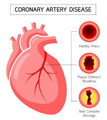 Coronary Artery Disease